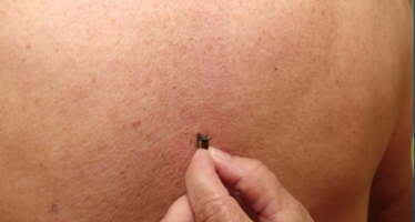 Apithérapie: Ils et elles se font piquer par des abeilles… exprès
